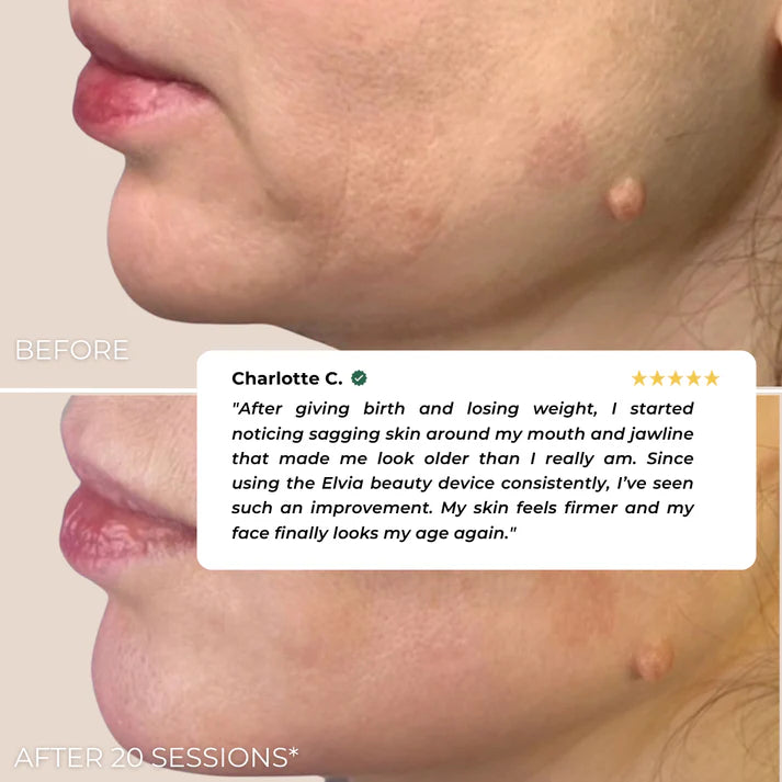 Nuvira™ EMS Beauty Device