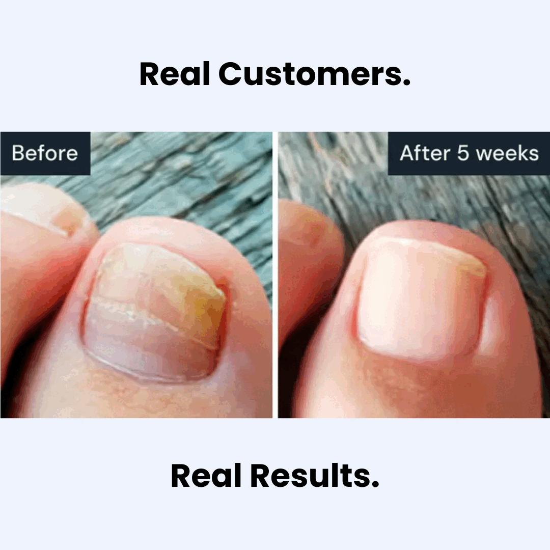 Nuvira™ Antifungal Pen