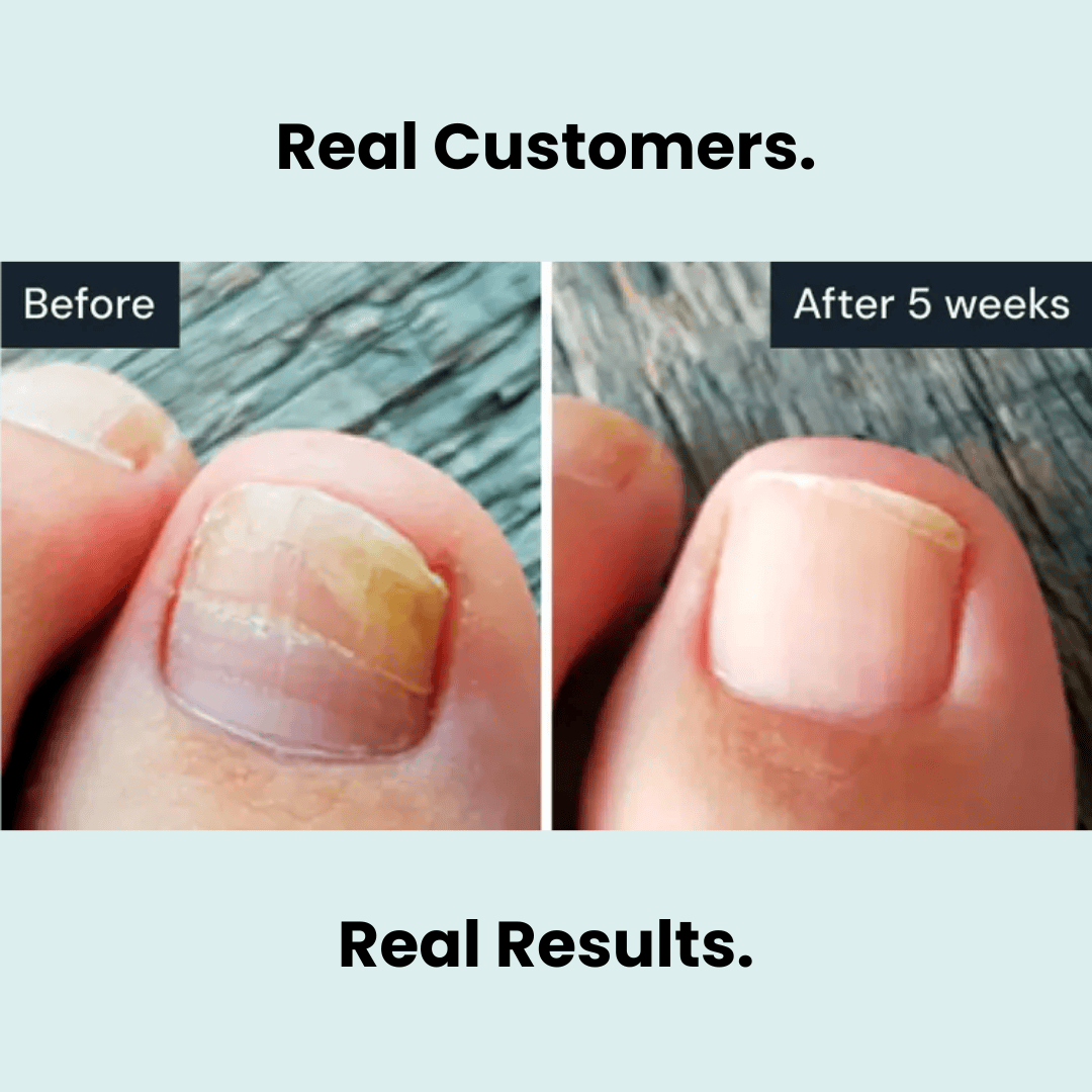 Nuvira™ Antifungal Pen